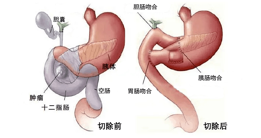 定西市第二人民医院完成全区首例全腹腔镜下胰十二指肠切除术