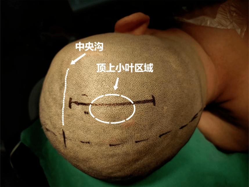 左侧卧位术中图片手术视频中央沟后方4.0cm,中线旁开3