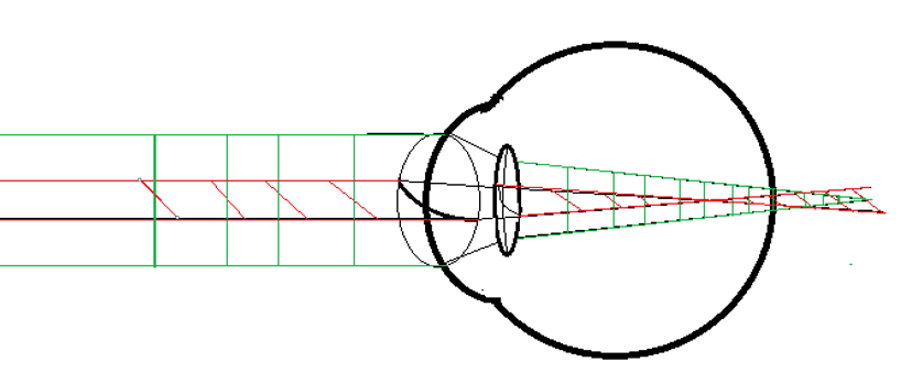 理解散光眼中的"史氏光锥"_角膜_成像_焦线
