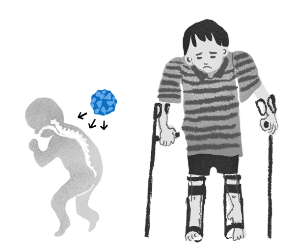 5,所以,脊髓灰质炎后遗症主要的症状就是导致肌肉和躯干的畸形通过不