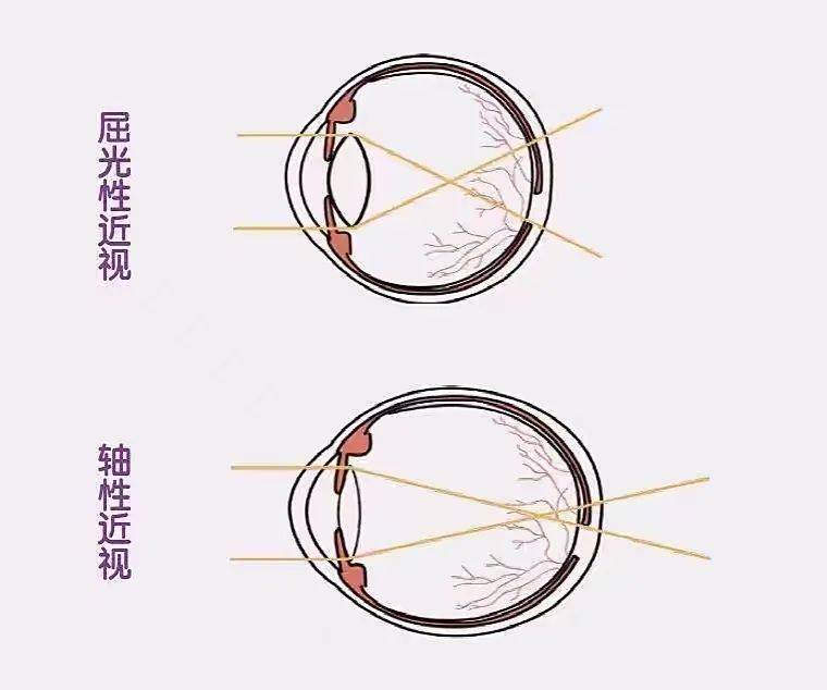 济南普瑞眼科科普_part_屈光_因素