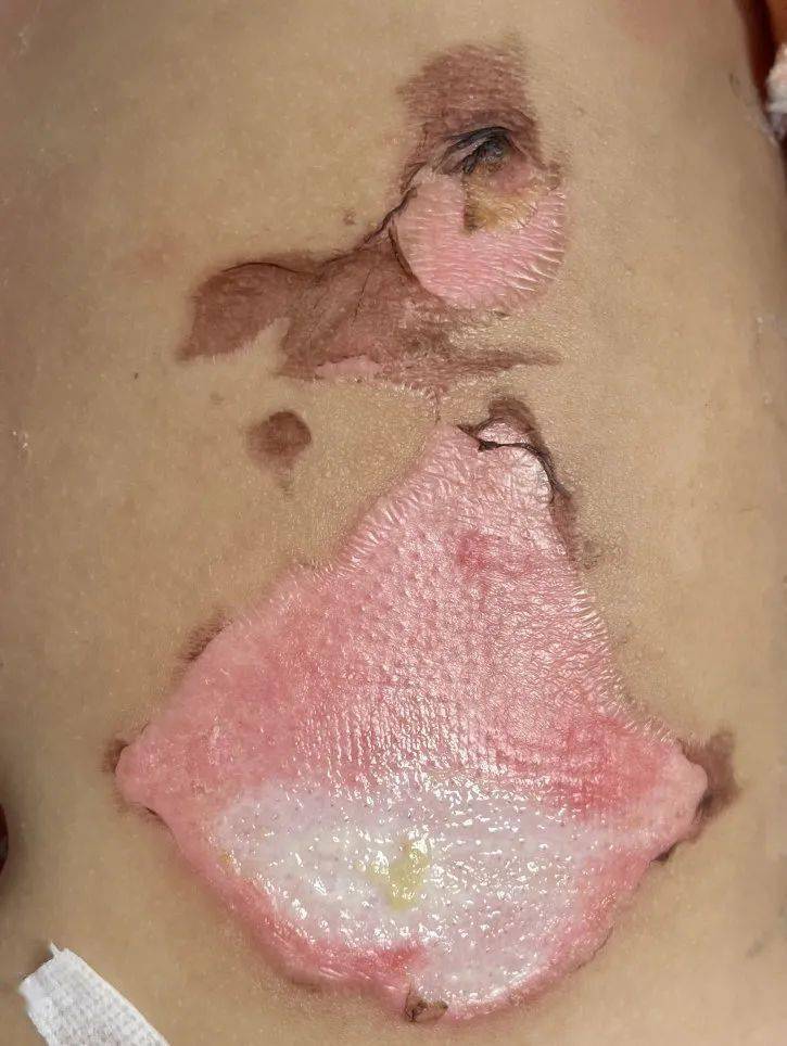 7个月大的婴儿被烫伤._孩子_皮肤_热水