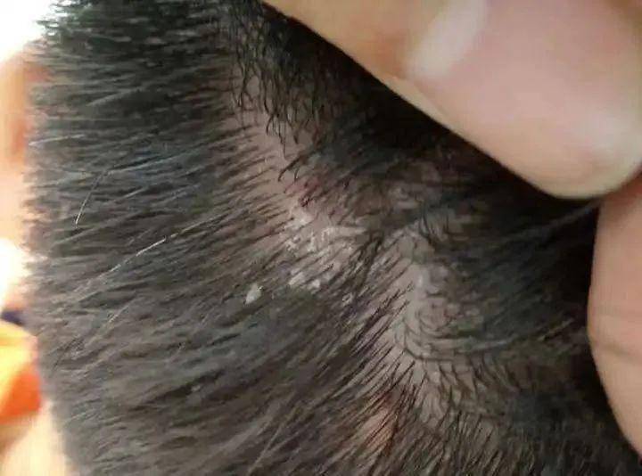 「杏林微科普」头皮屑增多,可能是银屑病复发或加重的征兆