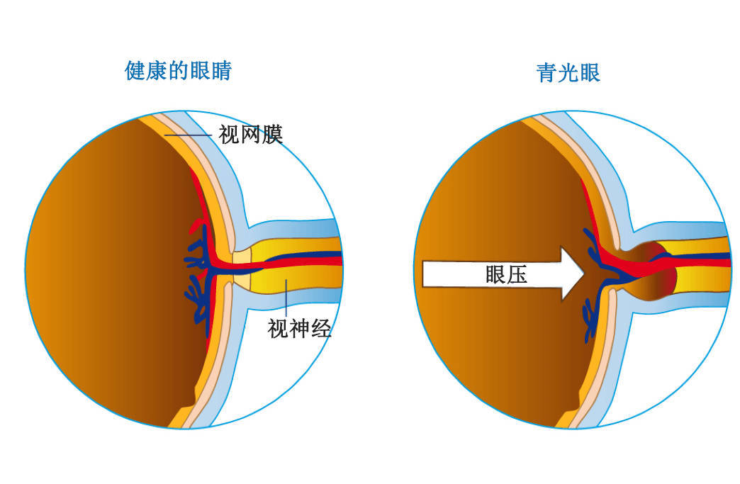 哪些人容易患青光眼?出现这些症状要注意!_视力_损伤_视神经