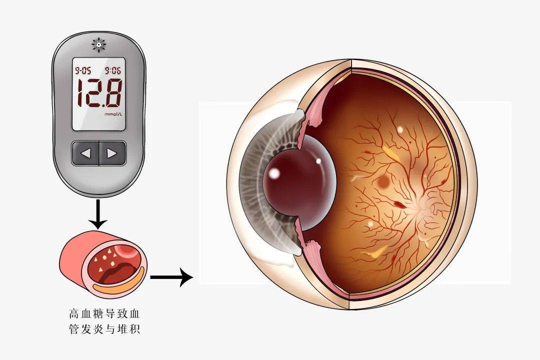 糖尿病视网膜病变怎么治疗?