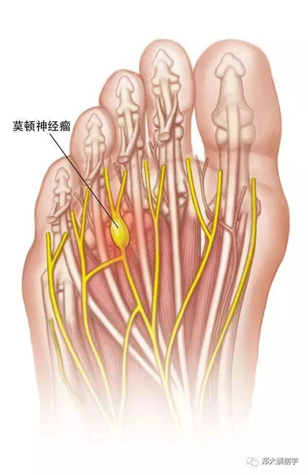 大脚趾麻木是怎么回事图片