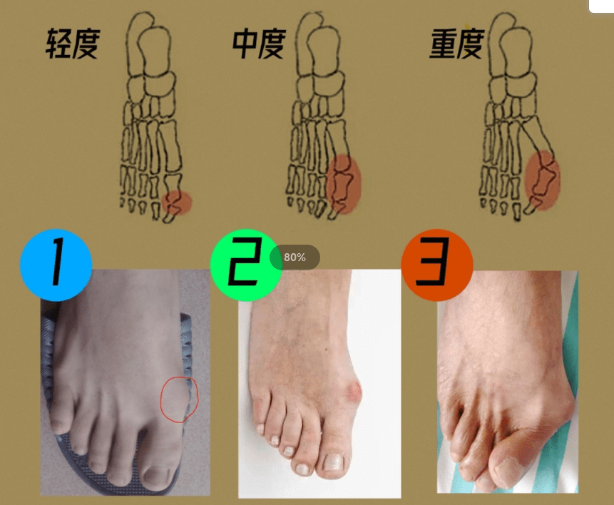 结构上的某些缺陷是拇外翻产生和加重的基础,如原发性跖骨内翻畸形,第