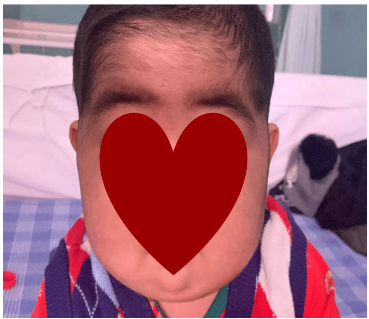 范翔教授:一例婴幼儿继发性青光眼引发的思考_眼压_手术_激素