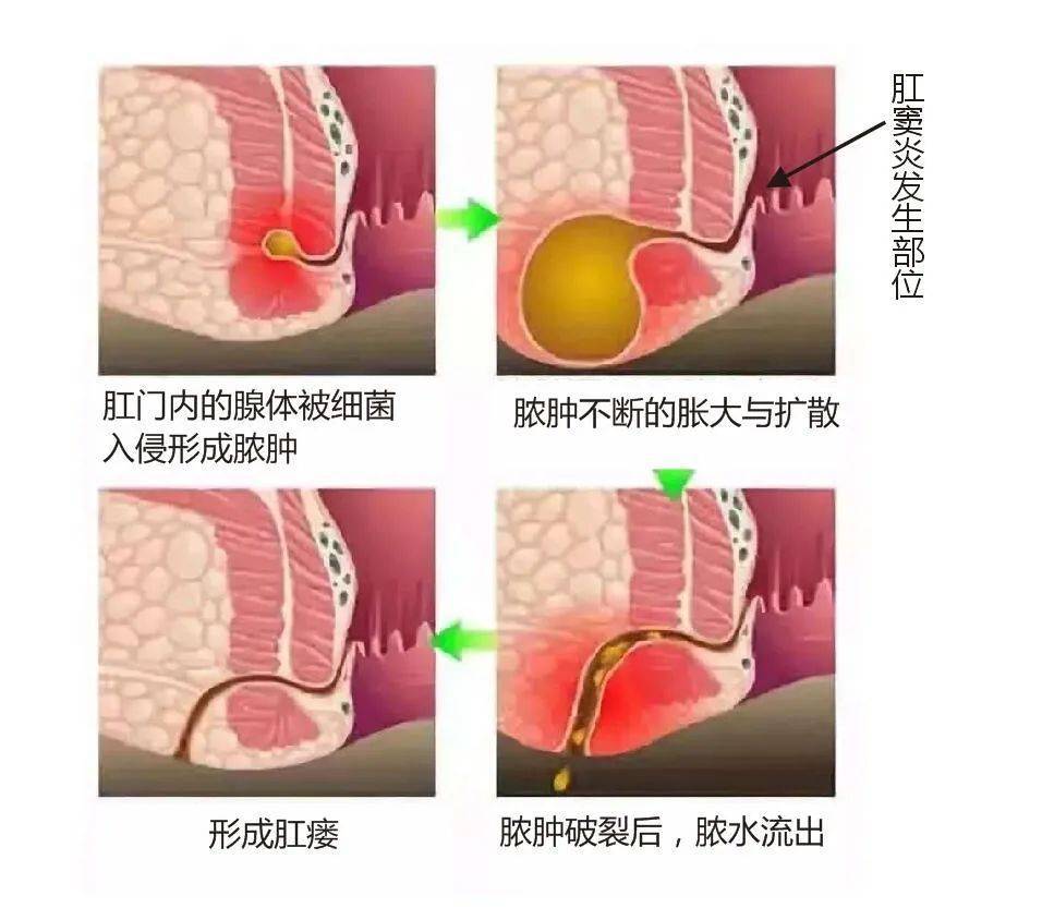 肛周囊肿早期图片初期图片