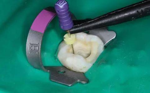 患者务必要尽早做牙根柱及牙套以保护剩余的齿质.