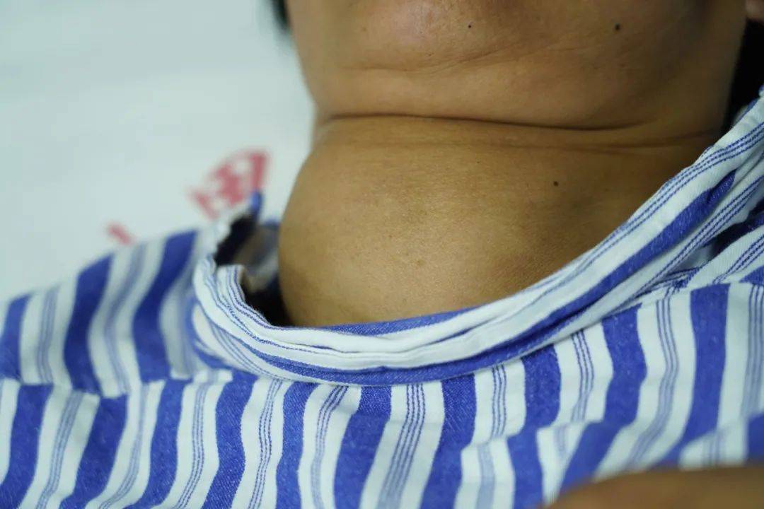 郑州中科甲状腺医院 | 甲状腺结节越大恶变几率越高?