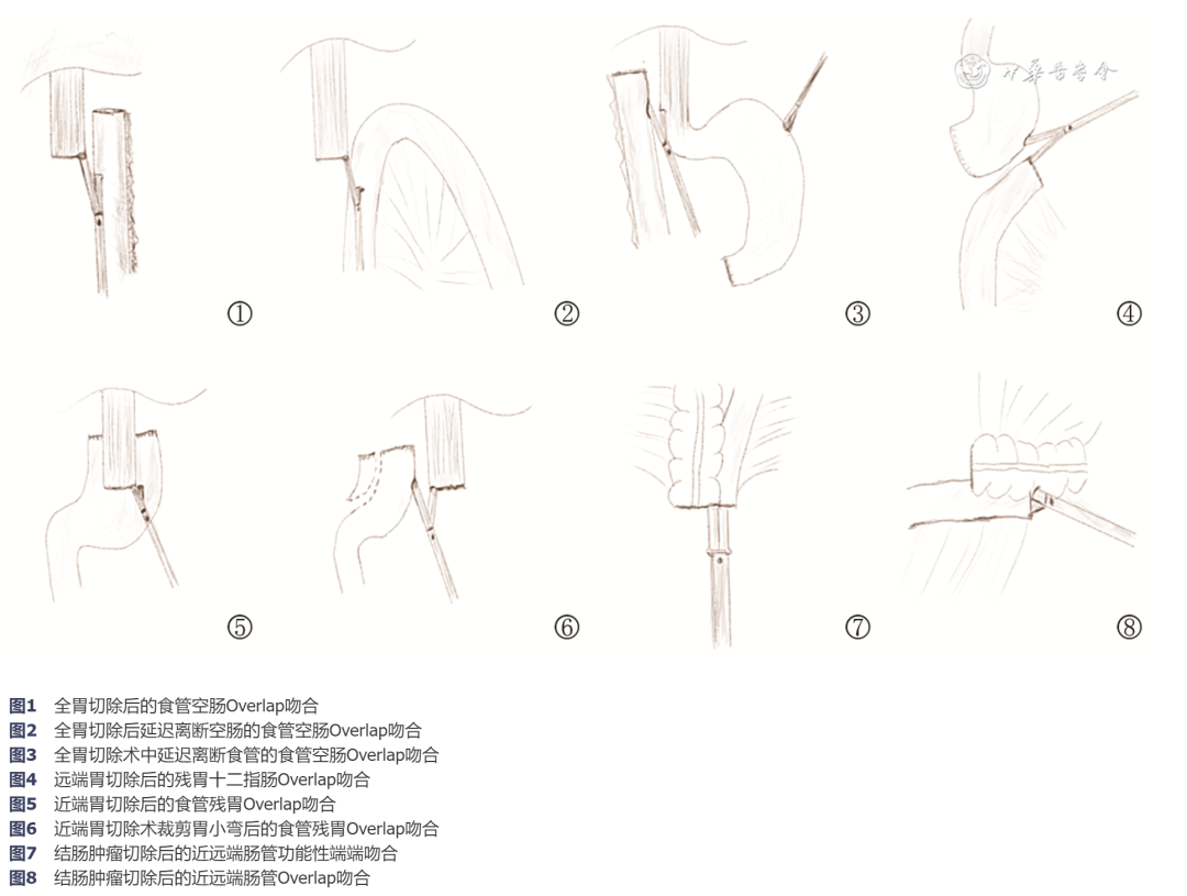ry吻合术图解图片