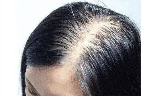 头发油腻又脱发怎么办?引起油性脱发的原因有哪些?
