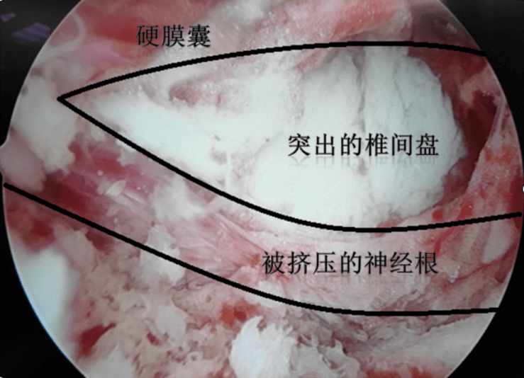 小小两个缝,根治腰腿痛_手术_脊柱_王叔