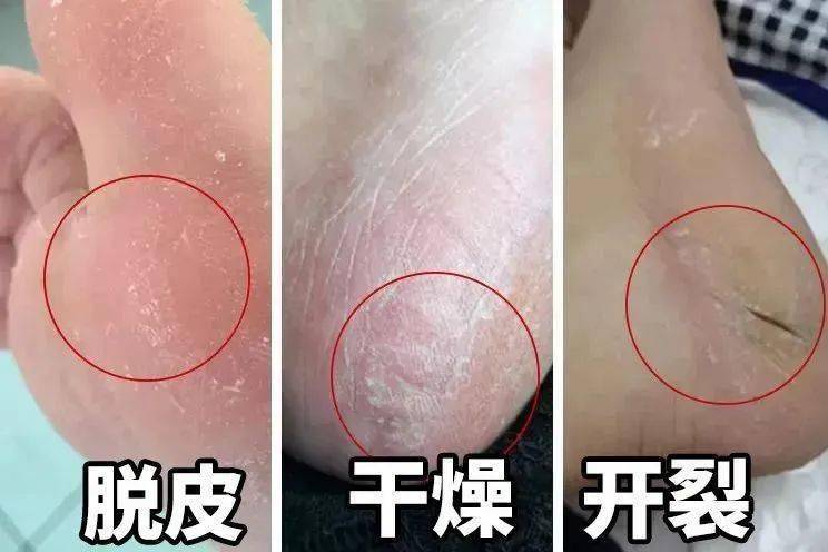 暴晒刺激的脚后跟,穿脱衣服或拿个什么东西都刺得疼01再是手指倒刺