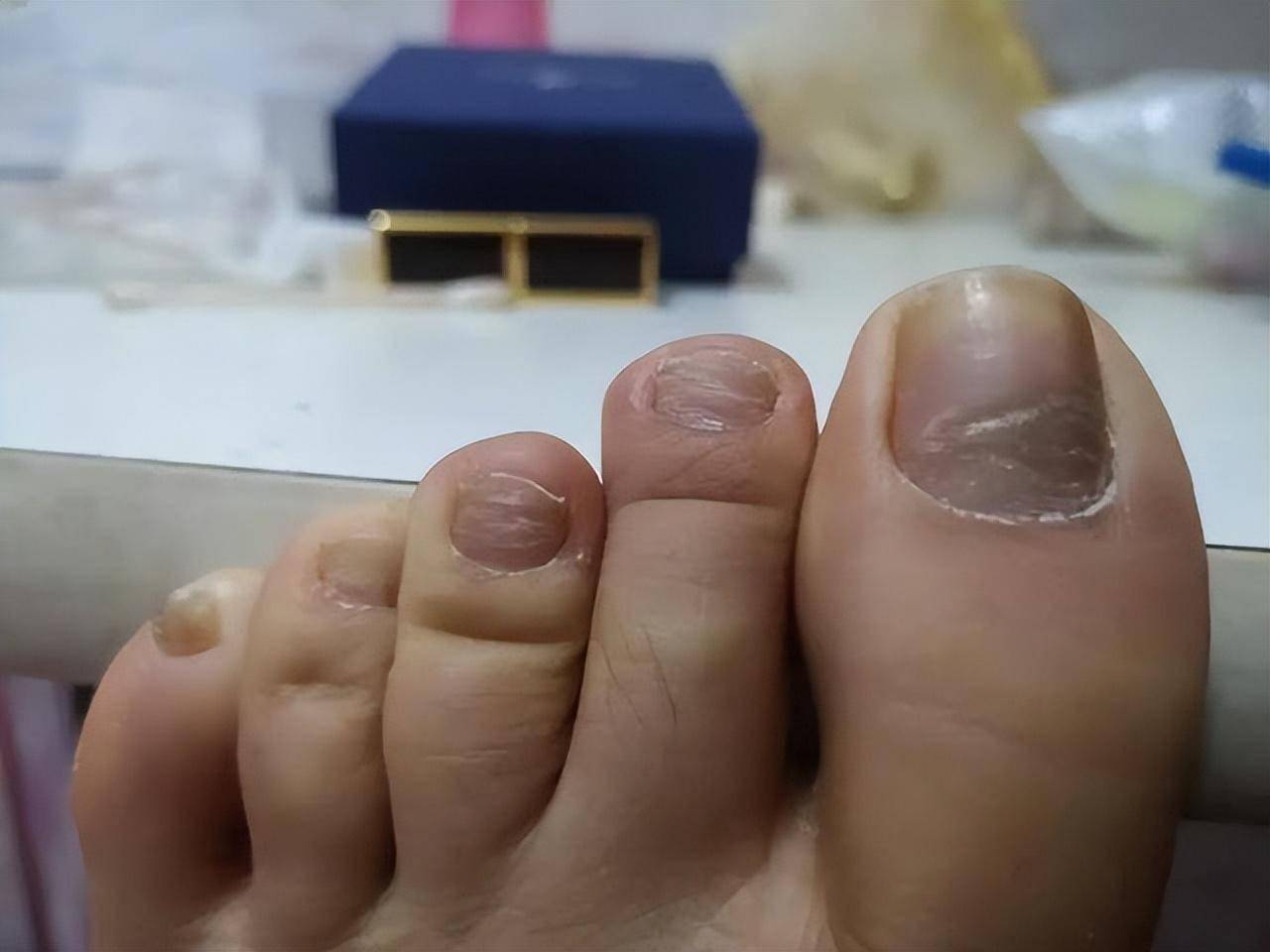 小脚趾指甲分成两瓣的人,到底是什么来历?你的指甲是这样的吗?
