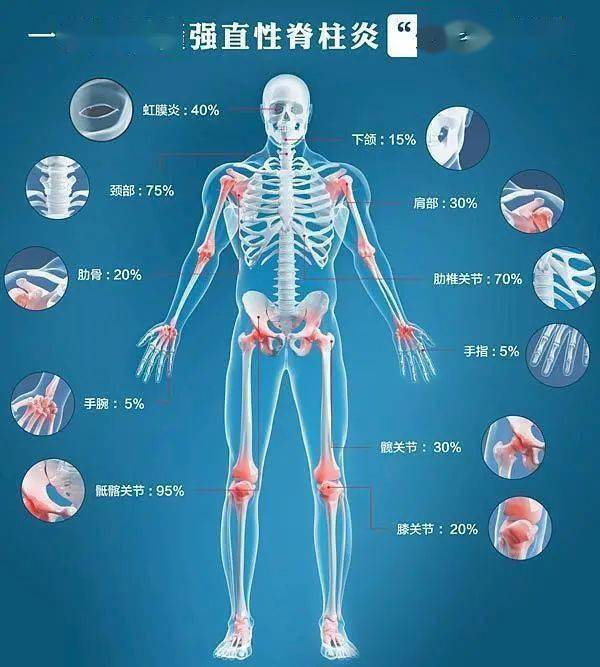 治" 强直性脊柱炎 " 的一个绝妙好方!_关节_正气_腰背