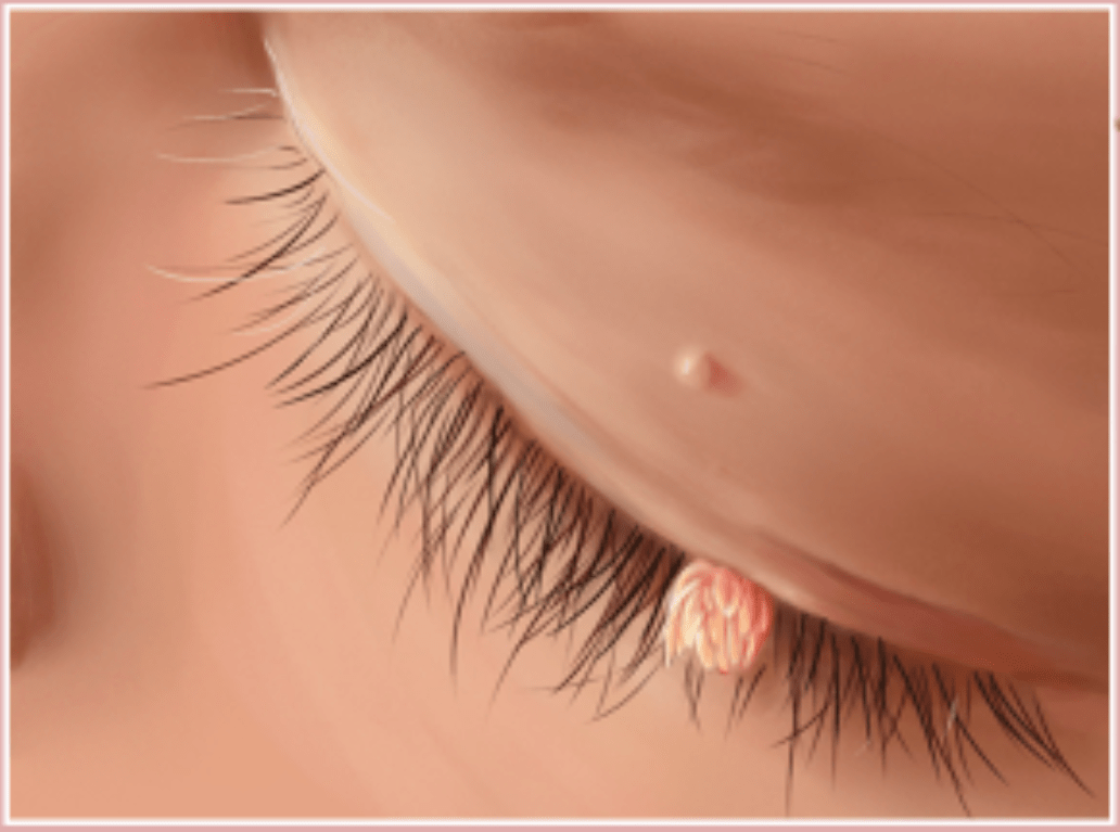 丝状疣:多发生在颈部,额头和眼睑.