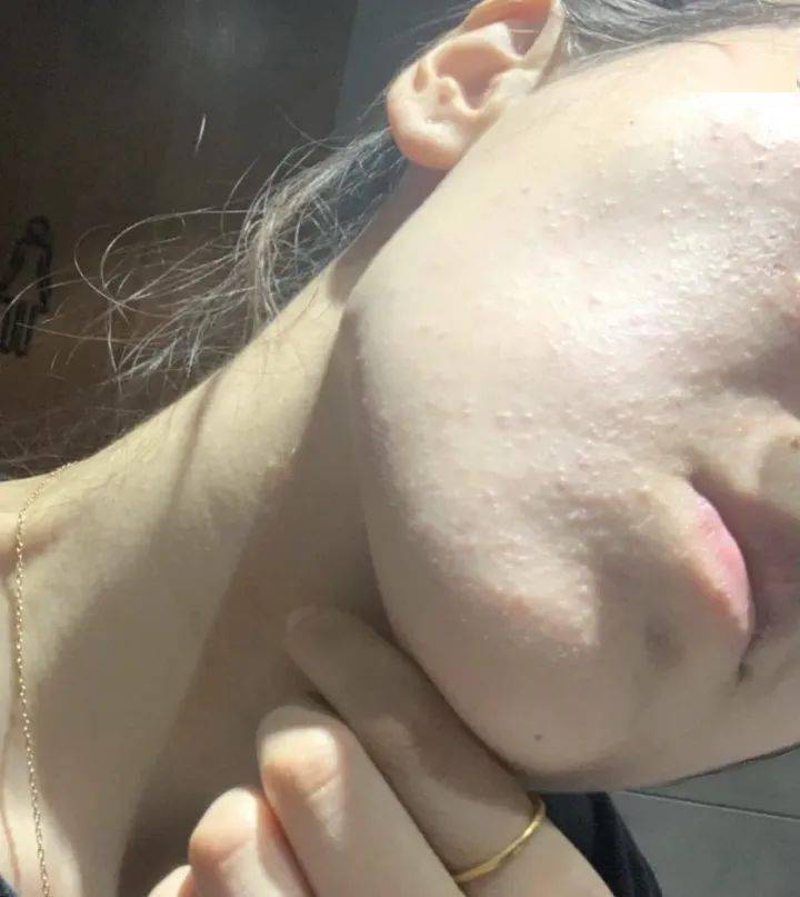 刷酸到底怎么刷?听医生忠告避免烂脸_皮肤_炎性_问题