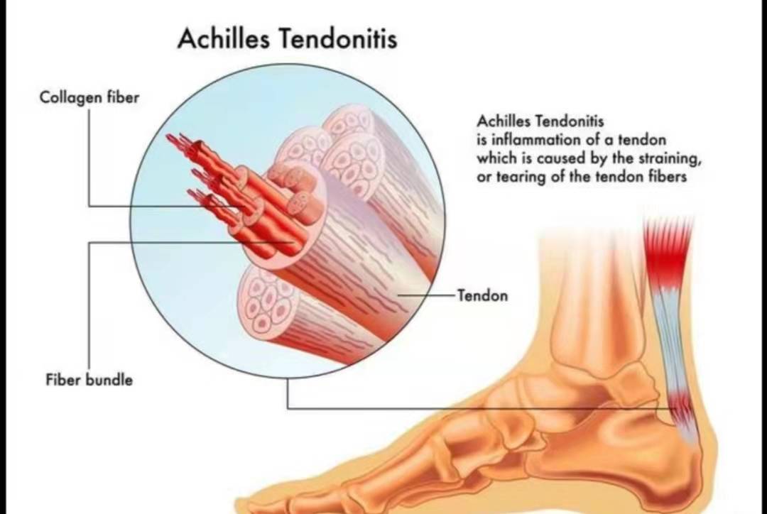 為了能解決跟腱炎!我徹底拼了!原來這才是正確方法!_肌肉_效果_肌腱