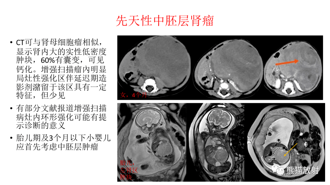 肾母细胞瘤 来自搜狐网