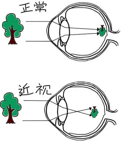 广州矫正视力手术哪家医院好,低度近视,可以做近视手术吗?