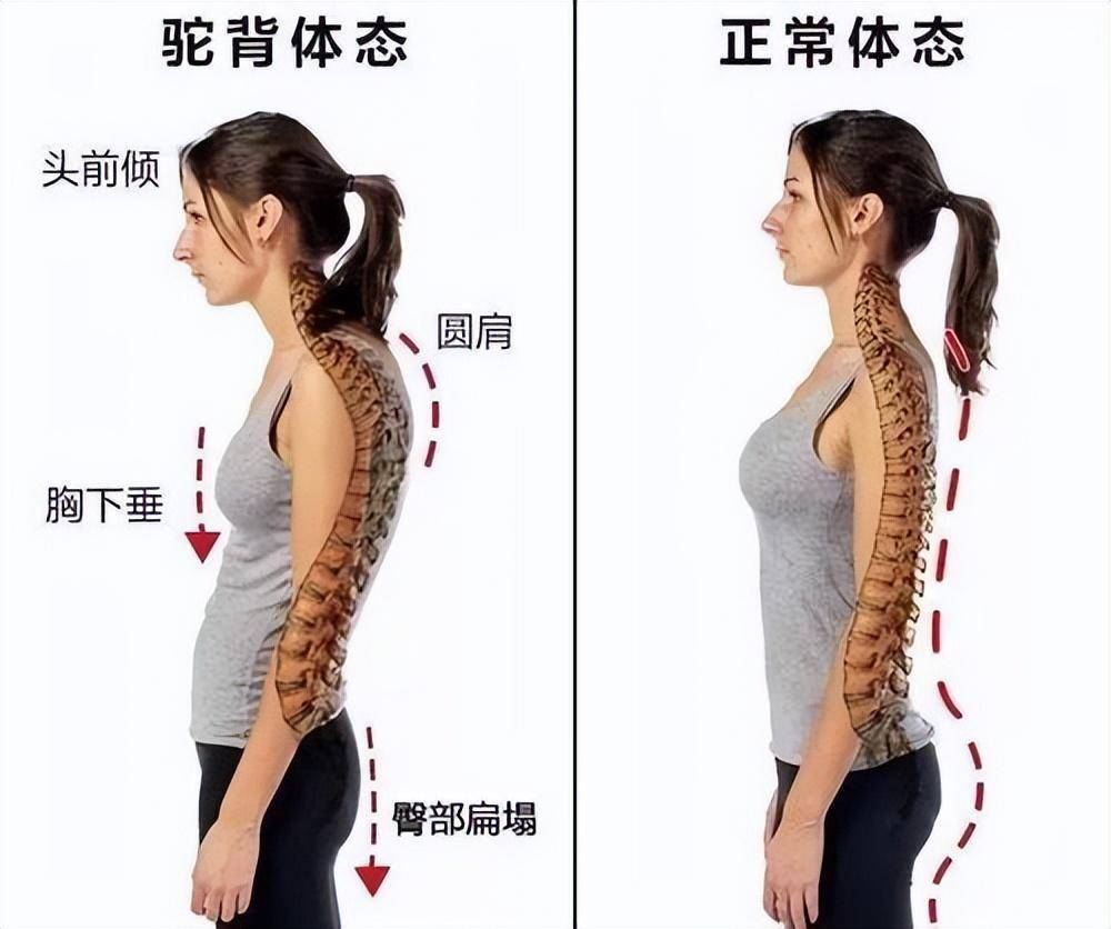 脖子前倾怎么办,颈椎曲度训练调整颈部肌肉方法