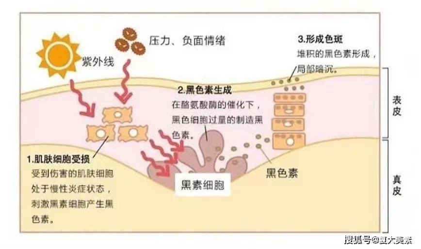 涨知识丨1min快速读懂黑色素的形成原因_皮肤_细胞_多巴