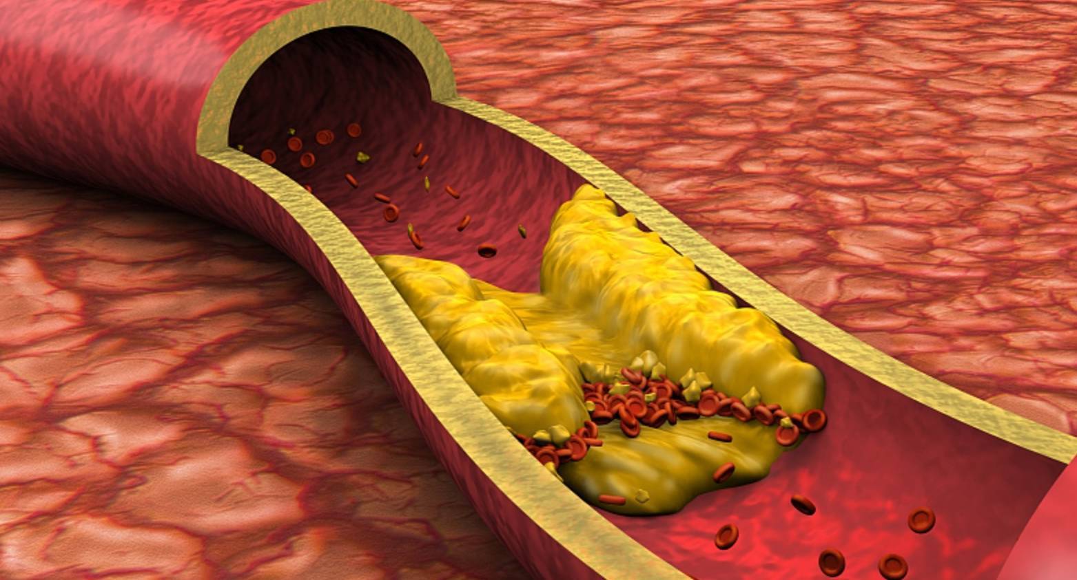 动脉硬化"偏爱"这几类人群,不想血管加速老化,坚持做好三件事_控制_患
