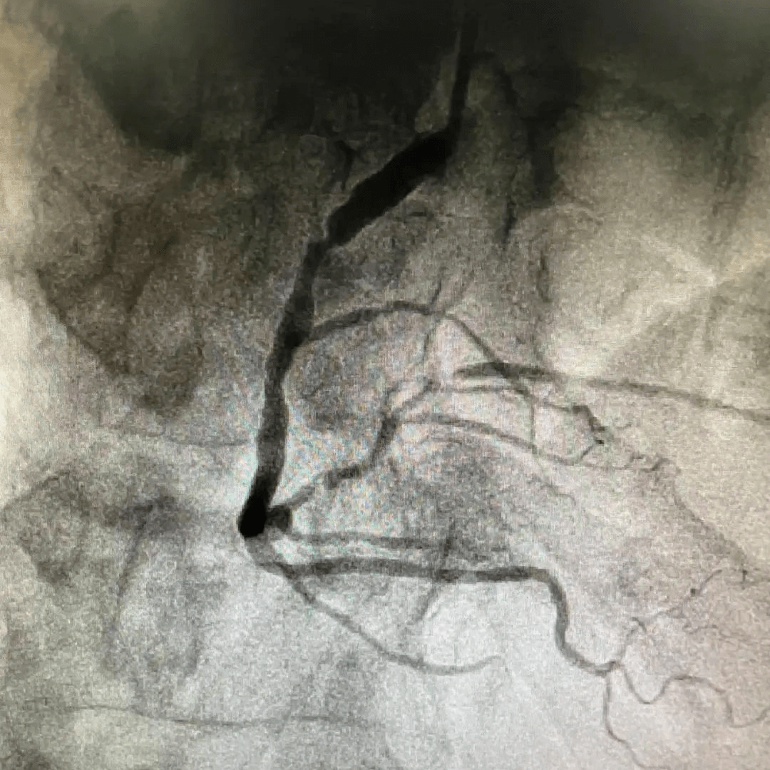 & optipass系统患者为72岁男性,因主诉"胸痛2年"入院,有高血压病史10