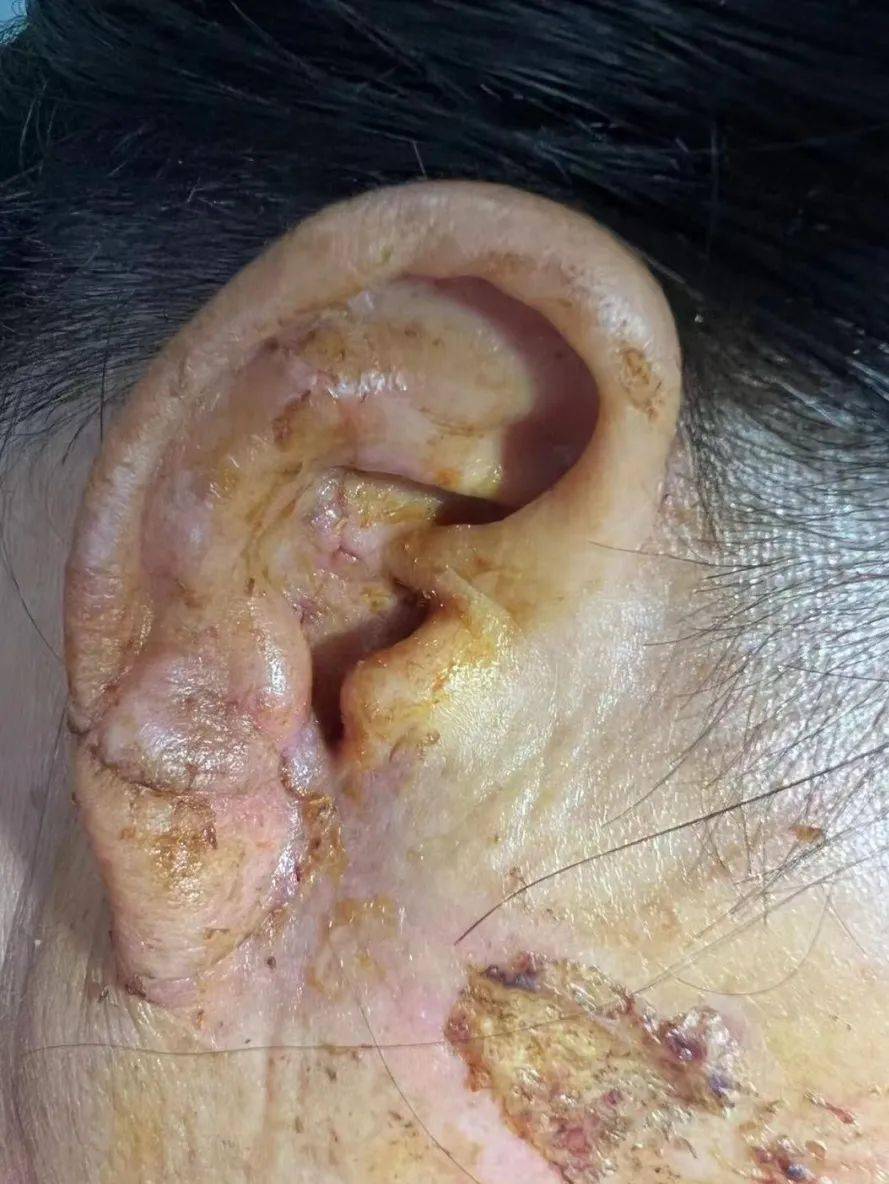 (拆线时)专家提醒耳廓外伤耳软骨断裂 ,做了清创缝合手术后如果不感染