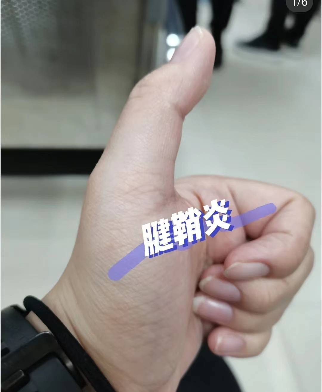 原來腱鞘炎是真的可以治好!知道這些方法輕鬆解決!_活動_yao_鍛鍊