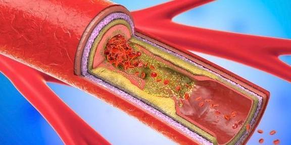 牢记3方法,让血糖高的人远离并发症_患者_脑血管_病变