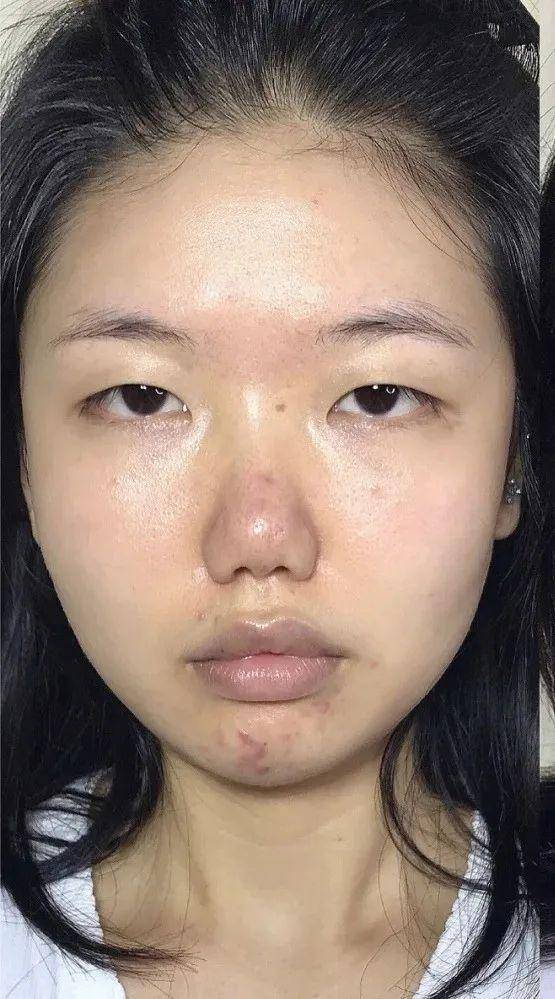 疲惫脸会出现的特征一般有眉毛耷拉,眼角下垂,法令纹超深,嘴角下撇