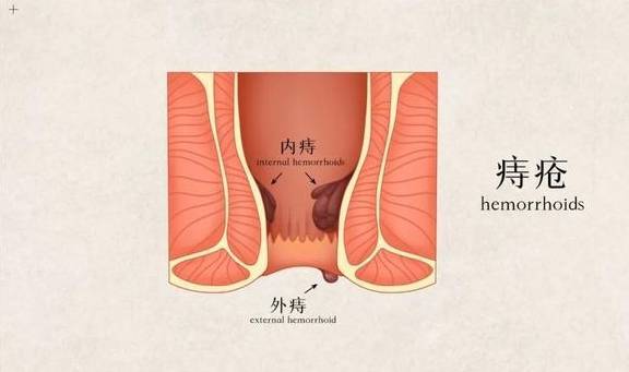 竟是因为这个人人都易患的病……_肛门_静脉_直肠_玉竹健康网