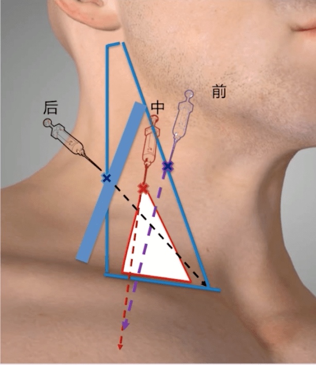 颈内静脉穿刺总失败?牢记这 3 个部位_导管_患者_中心