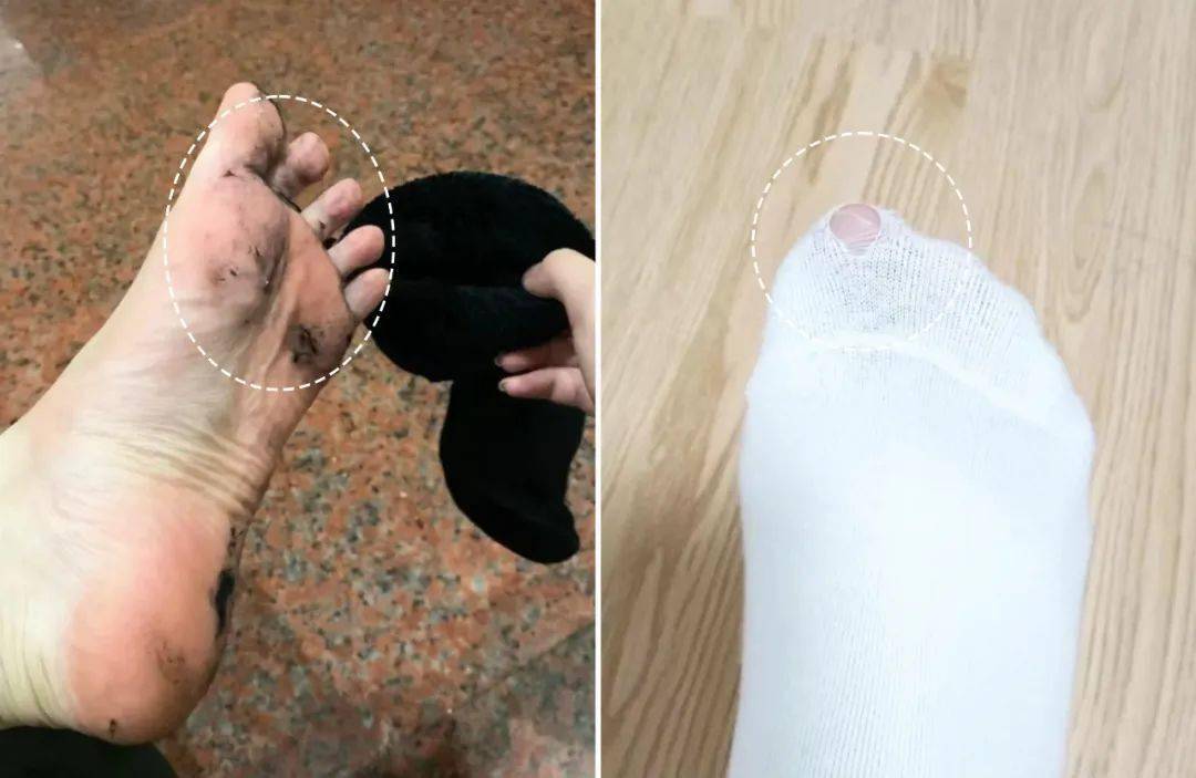 袜子_实验_病菌