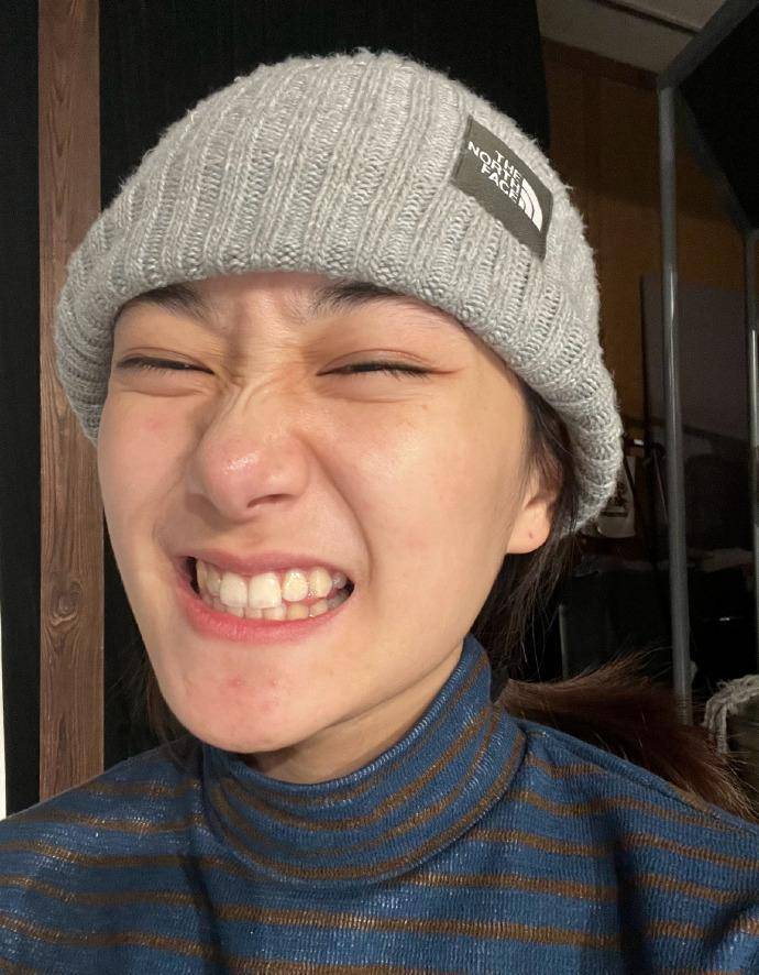孙艳的眼睛装萌,双眼眯成了一条线,下颌上的痘痘显露在下颌上,自嘲