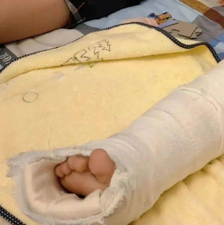 柳州一男孩在小区内骑自行车,不慎与小女孩相撞,致其骨折!