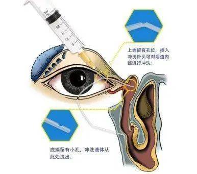 荆门爱尔眼科科普丨"泪道冲洗"能把堵塞的泪道冲开吗?_检查_治疗_阻塞