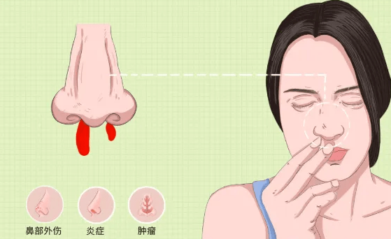 鼻中隔偏曲的五大原因,你中招了几个?_影响_软骨_症状