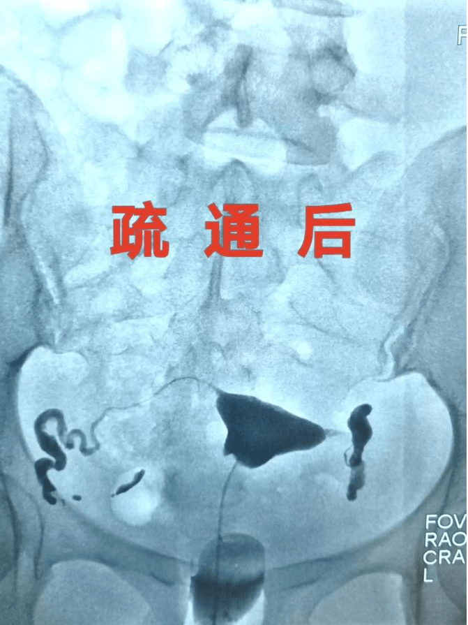 小手术解决大问题——北京友谊医院开展子宫输卵管造影及疏通术 解决