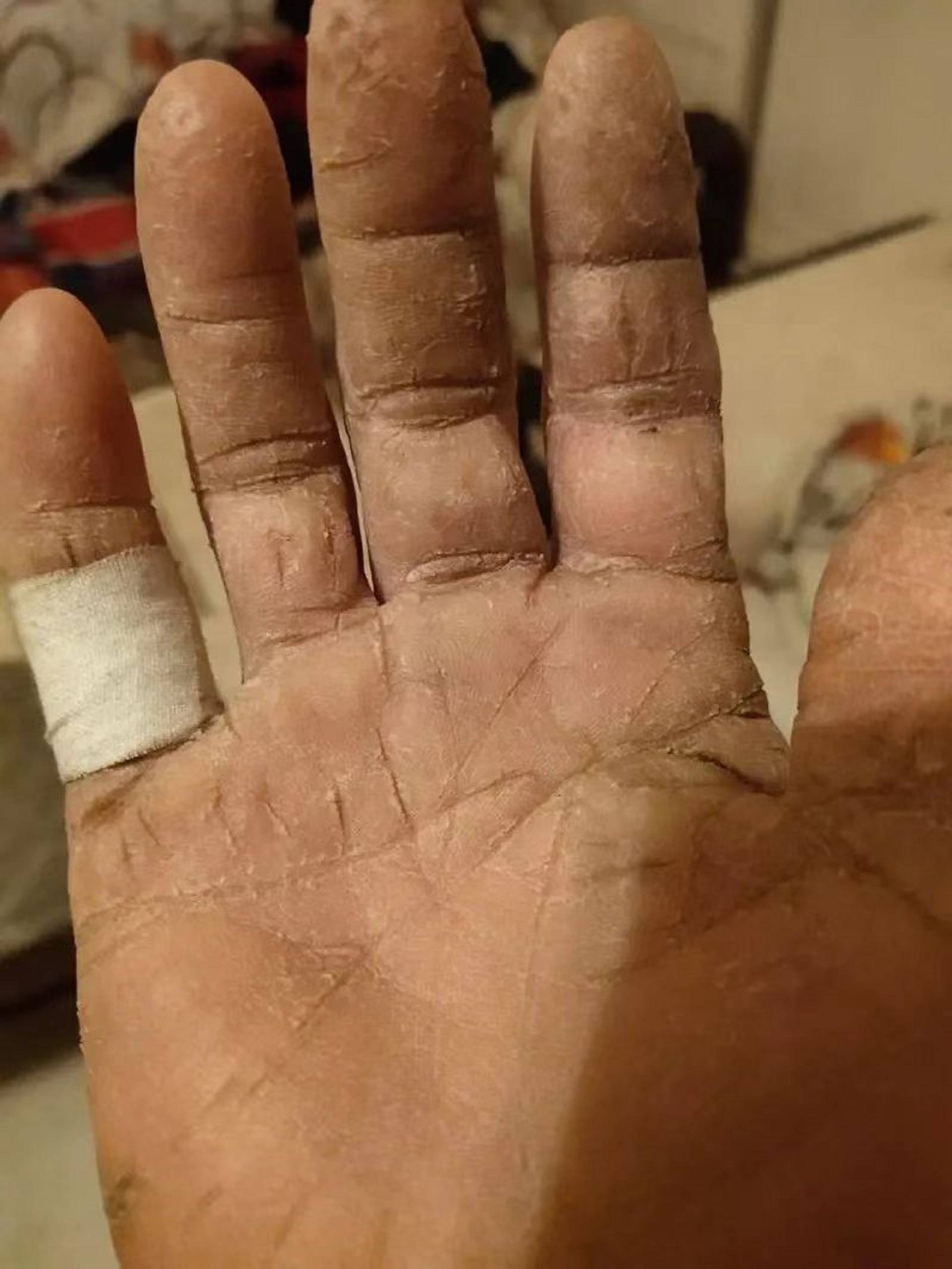 手背裂口爆皮好不了?别乱用保湿霜,过来人支你3招快速解决!