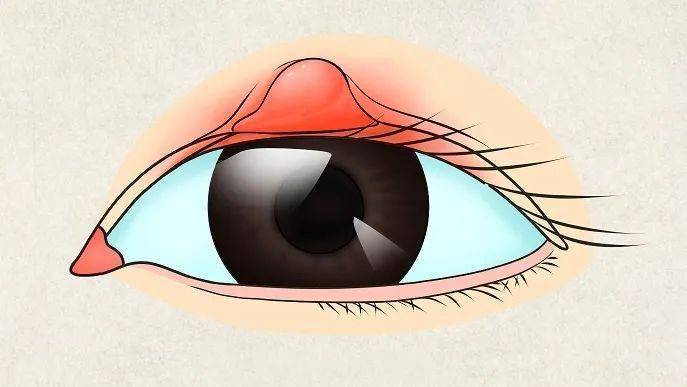 67霰粒腫和麥粒腫是不是一回事?一文看清楚!_眼瞼_腫塊_症狀