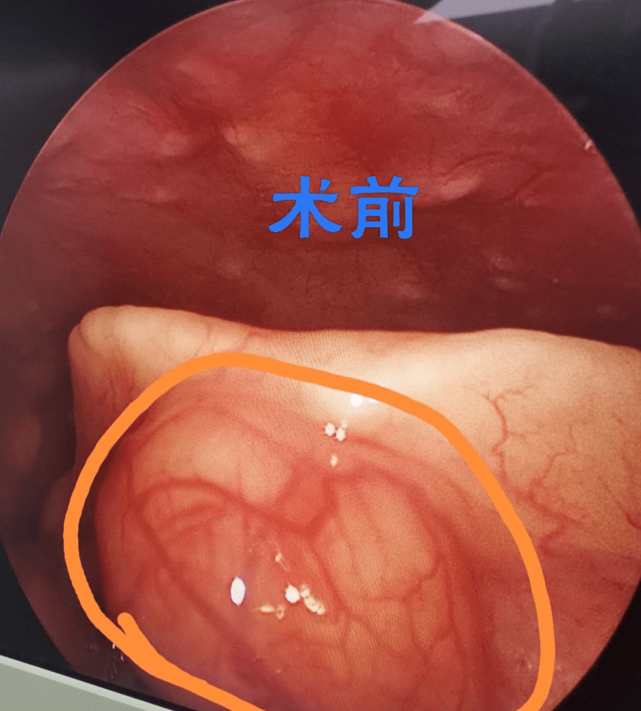 会厌囊肿手术过程图片图片