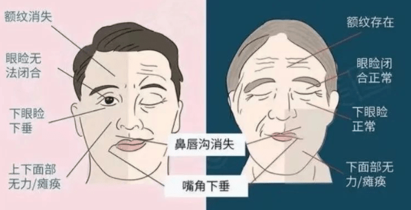 【深圳复亚医院康复医学科】周围性面瘫vs中枢性面瘫_侵袭_面部_面