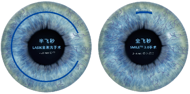 近视手术痛不痛？百年眼科医院|眼科医生这样说