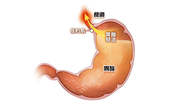 胃酸_治疗_降低