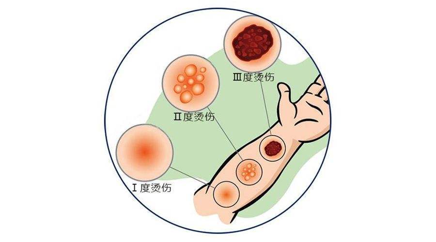 烧伤照片 卡通图片图片