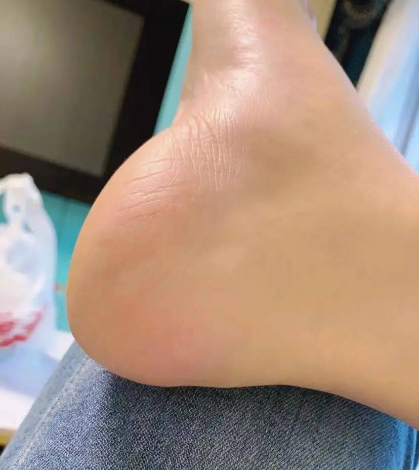 67秋冬脚后跟裂口疼痛难忍,用一小方法,脚后跟光滑柔嫩,不花钱!